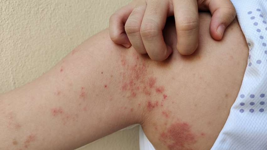 penyebab-impetigo-pada-anak-dan-cara-mengatasinya