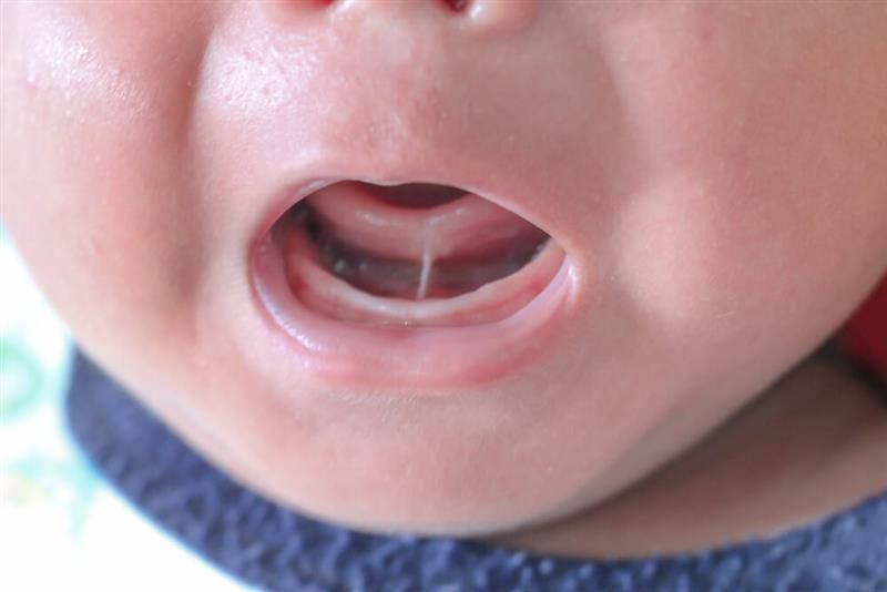 apakah-tongue-tie-pada-bayi-dapat-diobati