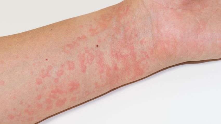 biduran-pada-anak-penyebab-dan-ciri-yang-perlu-diketahui