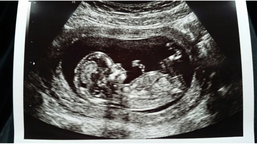 Oligohidramnion: Kondisi Air Ketuban Sedikit Saat Hamil