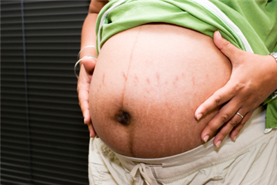 Cara Mengatasi Stretch Mark Saat Hamil