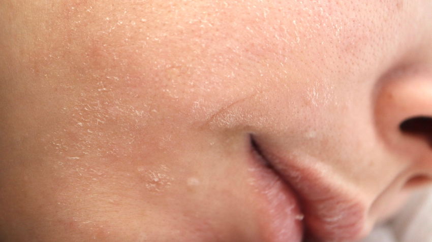 Kulit Wajah Kering saat Hamil: Penyebab, Ciri, dan Cara Mengatasinya