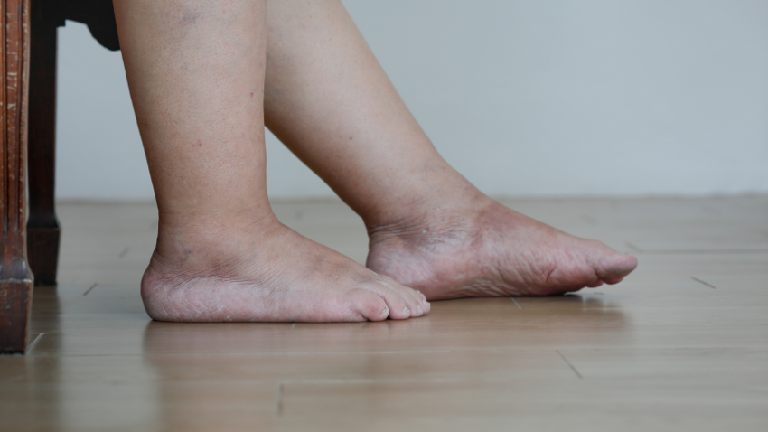 Kaki Bengkak Setelah Persalinan, Ini Cara Menguranginya