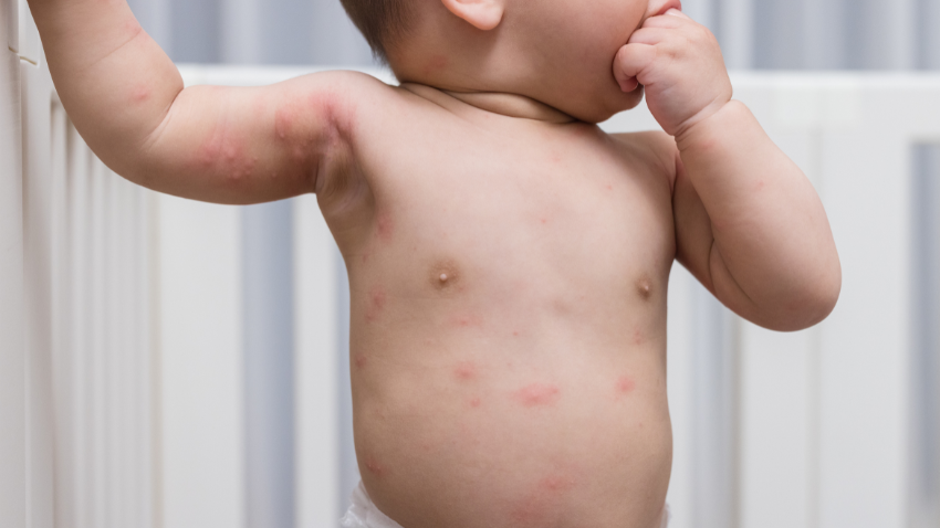 alergi-pada-bayi-pahami-penyebab-dan-cara-mengobatinya