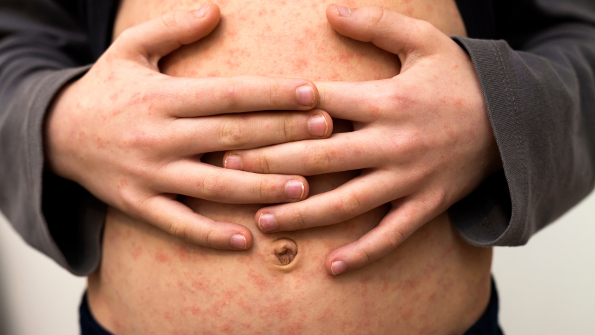 Cara Menghilangkan Bekas Campak pada Anak dengan Aman