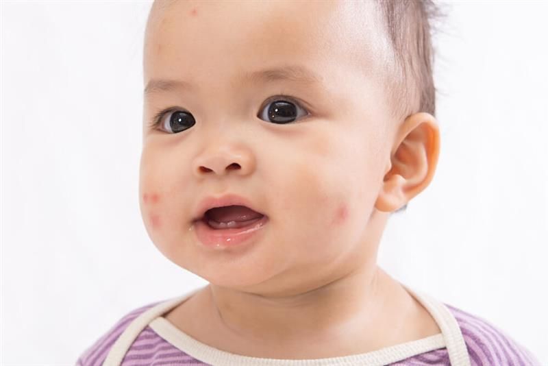 alergi-pada-bayi-pahami-penyebab-dan-cara-mengobatinya