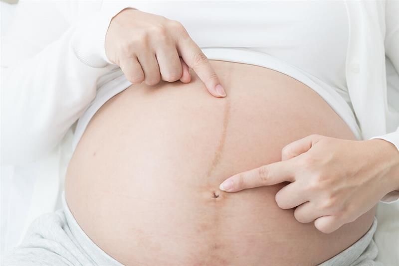linea-nigra-garis-hitam-memanjang-pada-perut-ibu-hamil